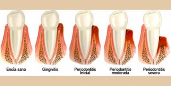 Las encías también existen: alertas sobre gingivitis y periodontitis