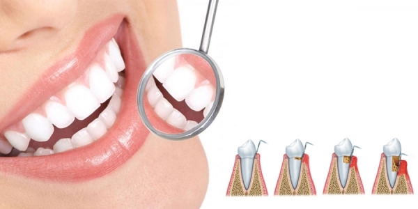 PERIODONCIA  / Clínica Dental Alfaro